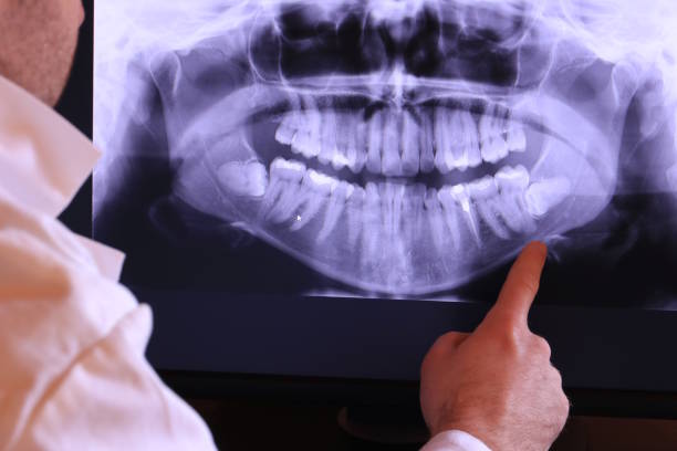 Best Emergency Treatment for Dental Infections or Abscesses in Lincolnia, VA