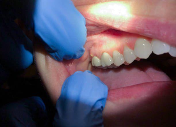Best Emergency Tooth Extraction in Lincolnia, VA