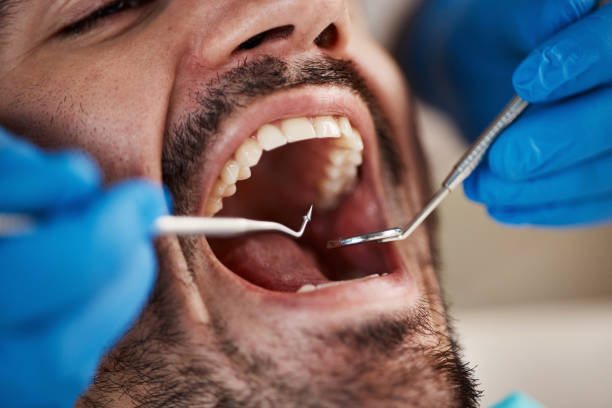 Best Emergency Wisdom Teeth Removal in Lincolnia, VA